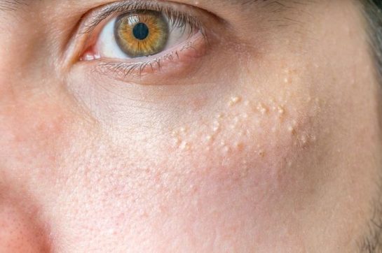 Banish Milia: Those Annoying Little Bumps!