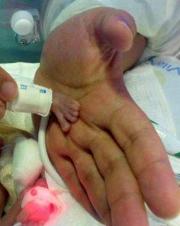 One of the smallest babies in the world was born..!